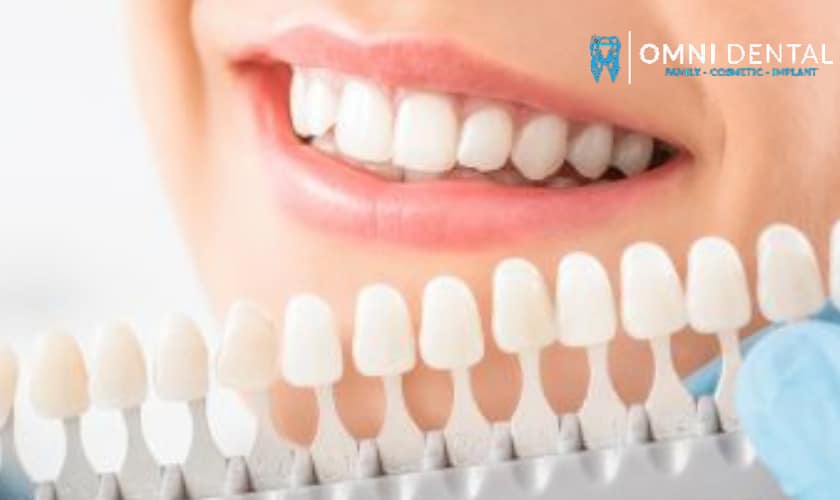 Know The Major Benefits Of Dental Veneers